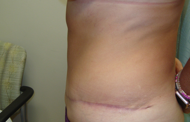 Side view of a patient's midsection after a tummy tuck procedure.