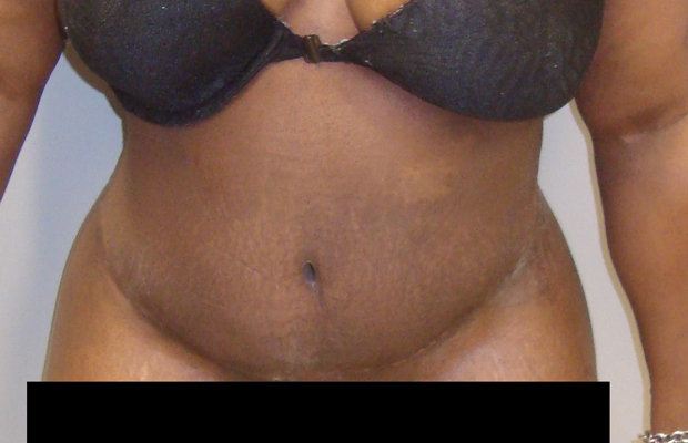Front view of a patient's midsection after a tummy tuck procedure.
