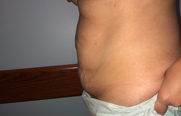 Side view of a patient's midsection before a tummy tuck procedure.