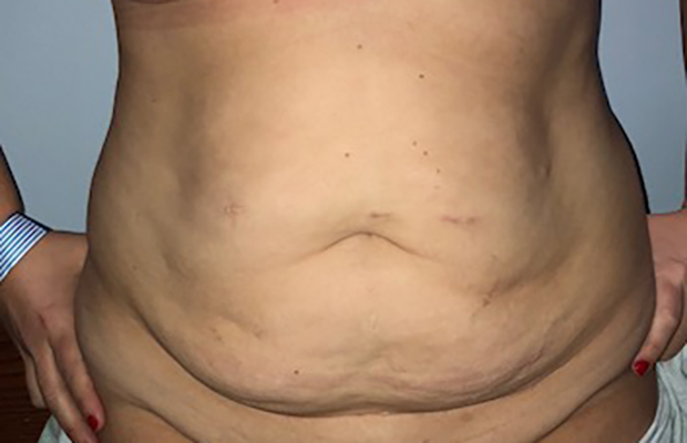 Front view of a patient's midsection before a tummy tuck procedure.