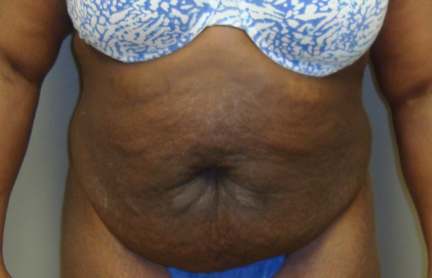 Front view of a patient's midsection before a tummy tuck procedure.