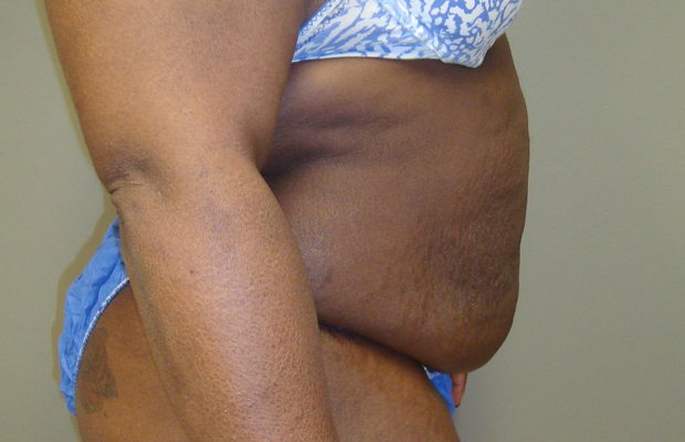 Side view of a patient's midsection before a tummy tuck procedure.
